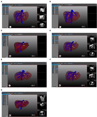 Anatomical Study of the Hepatic Veins in Segment 4 of the Liver Using Three-Dimensional Visualization